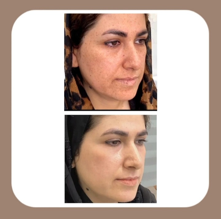 خرید کرم _ضد لک_ لاکچری کوین_وایتکس پوست کاملا اصل با ضمانت تحت لیسانس فرانسه لاکچری کوین - فروشگاه زیبایی با بیتا